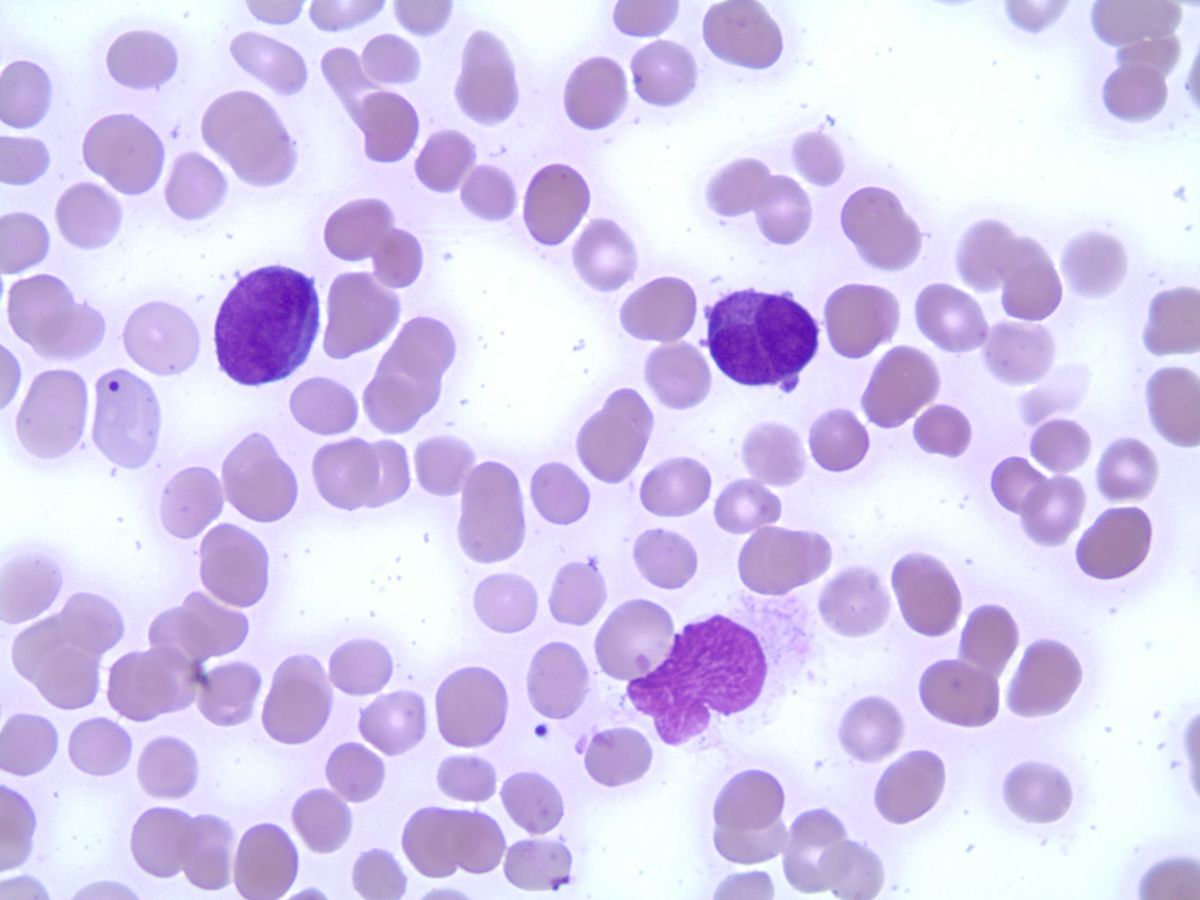 Blasts with bilobed nuclei and prominent nucleoli